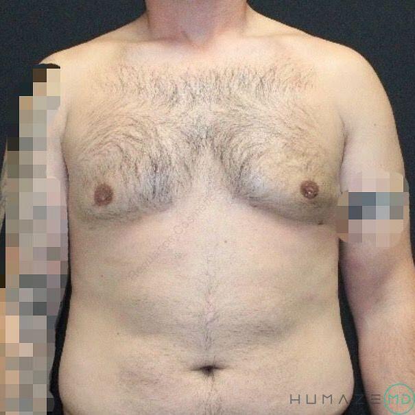 Gynecomastia Surgery Before & After Image