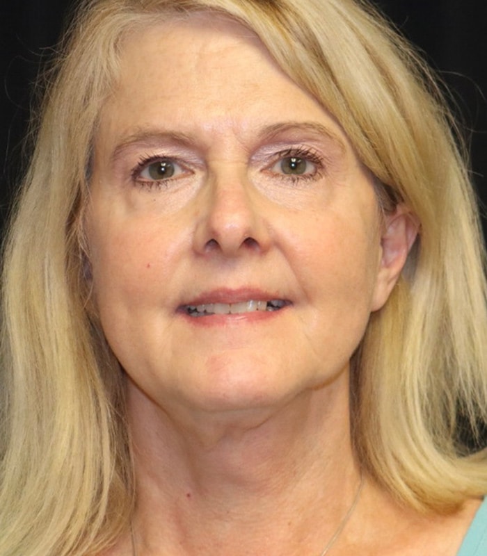 Blepharoplasty Before & After Image