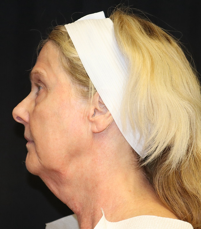 Blepharoplasty Before & After Image