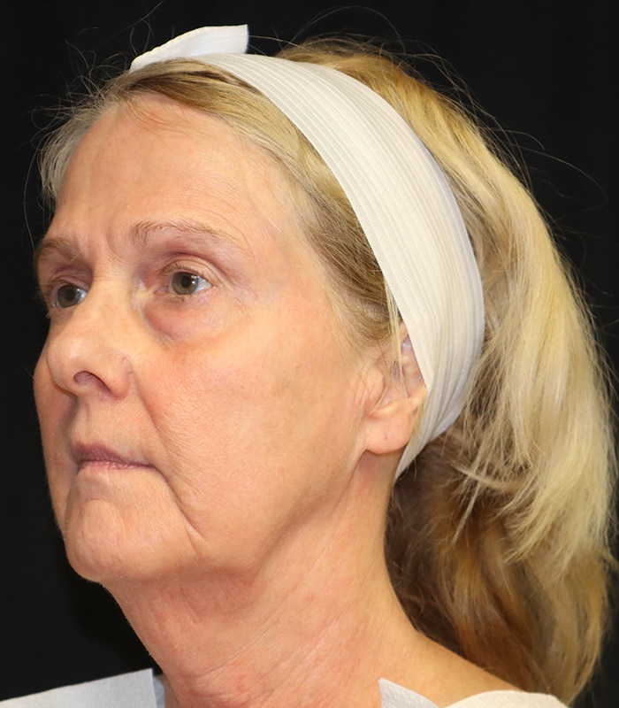 Blepharoplasty Before & After Image