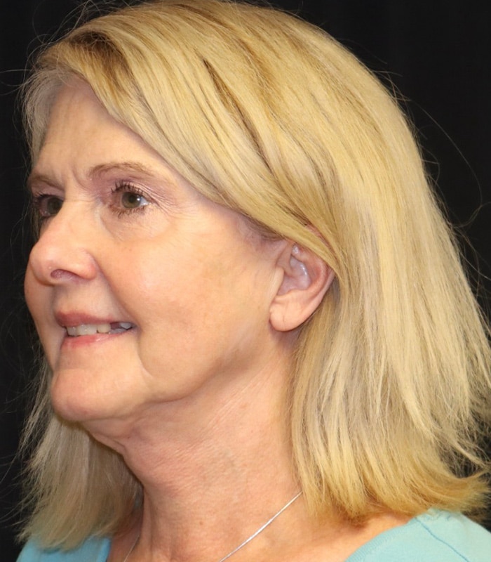 Blepharoplasty Before & After Image