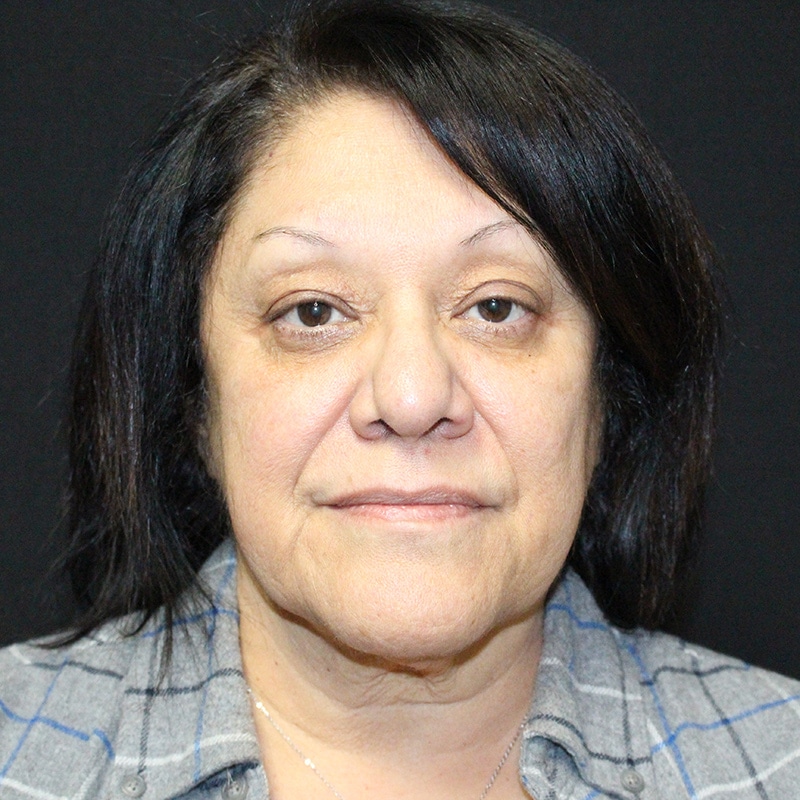 Blepharoplasty Before & After Image