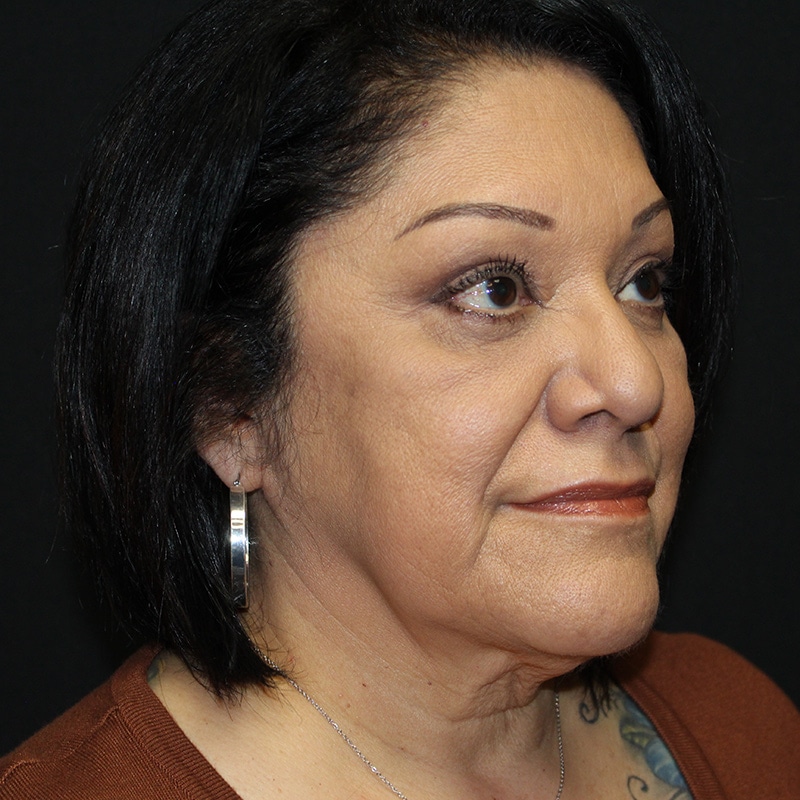 Blepharoplasty Before & After Image