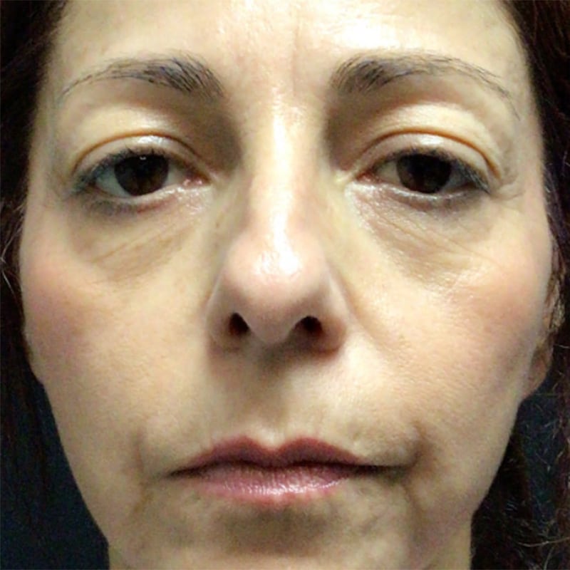 Blepharoplasty Before & After Image