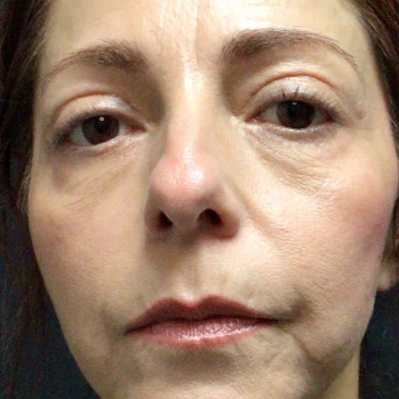 Blepharoplasty Before & After Image