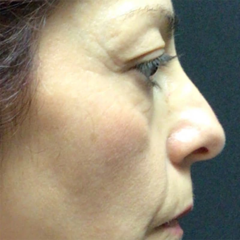 Blepharoplasty Before & After Image