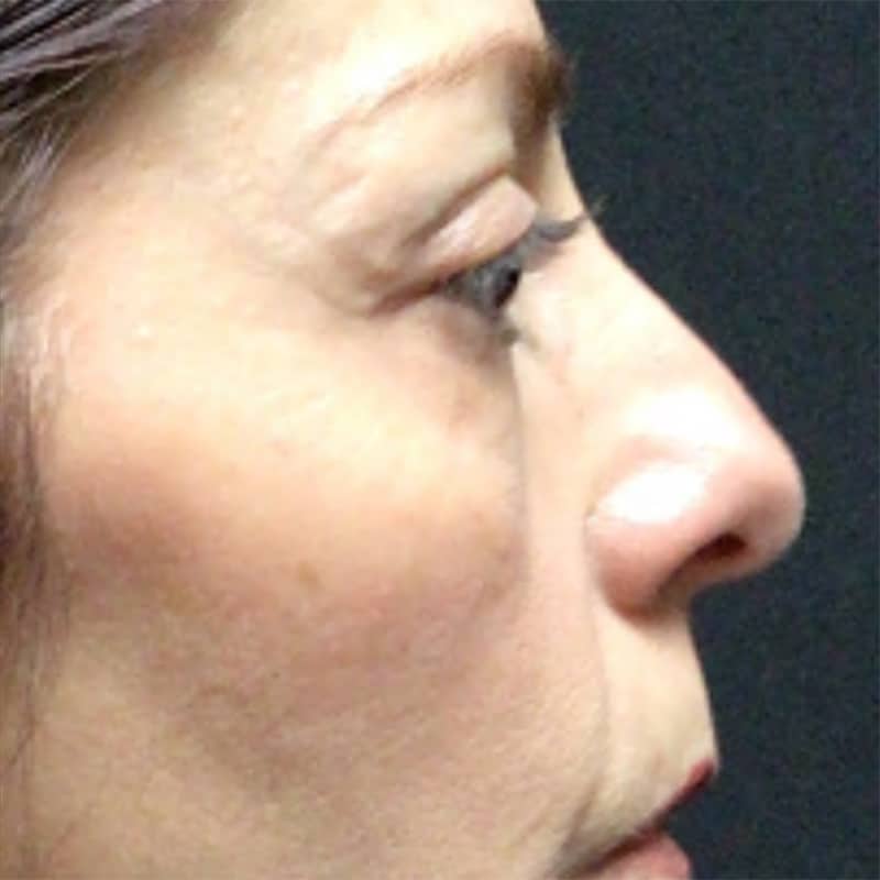 Blepharoplasty Before & After Image