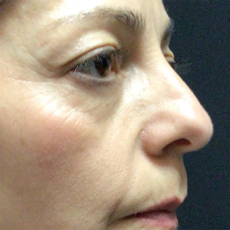 Blepharoplasty Before & After Image