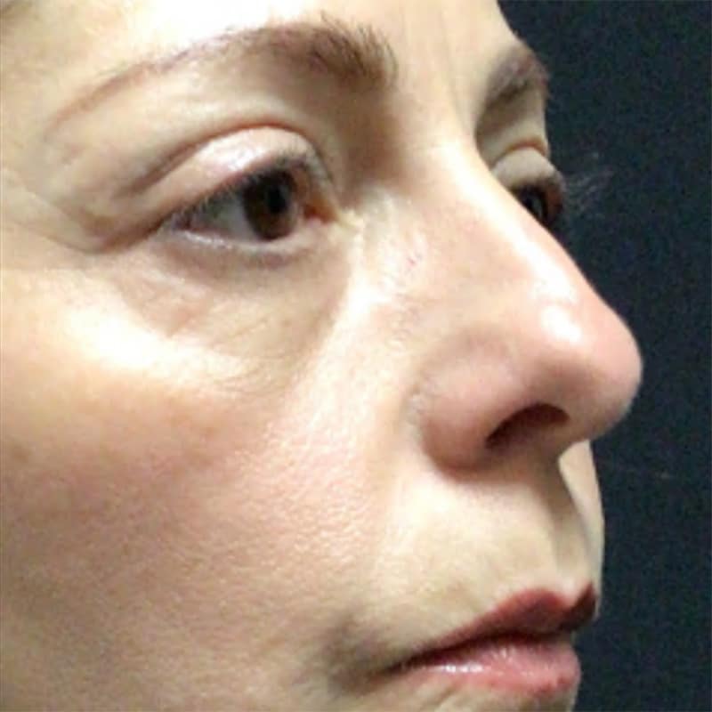 Blepharoplasty Before & After Image