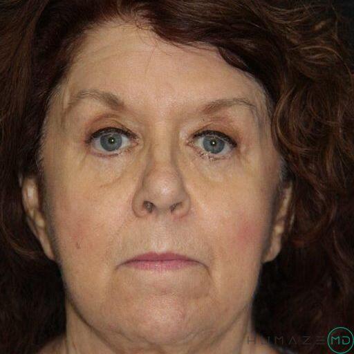 Blepharoplasty Before & After Image