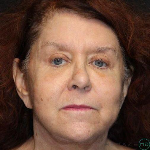 Blepharoplasty Before & After Image