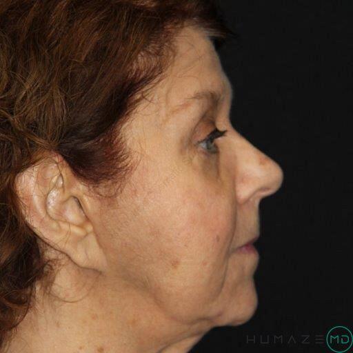 Blepharoplasty Before & After Image