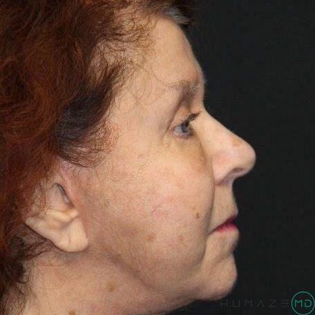 Blepharoplasty Before & After Image