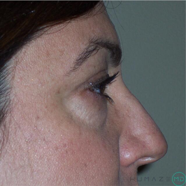 Blepharoplasty Before & After Image