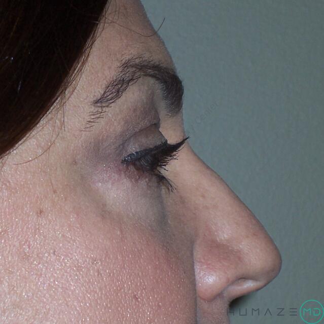 Blepharoplasty Before & After Image