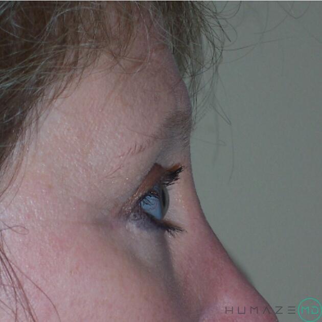 Blepharoplasty Before & After Image