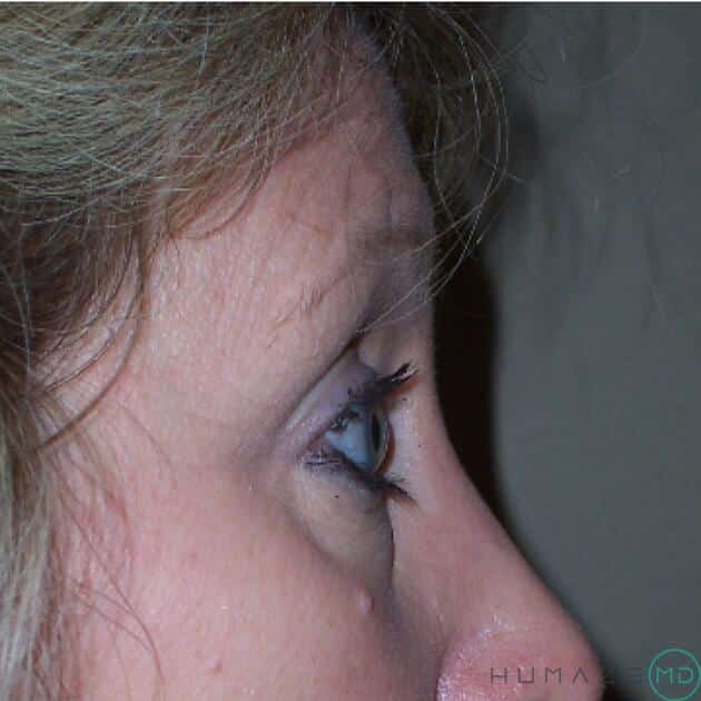 Blepharoplasty Before & After Image