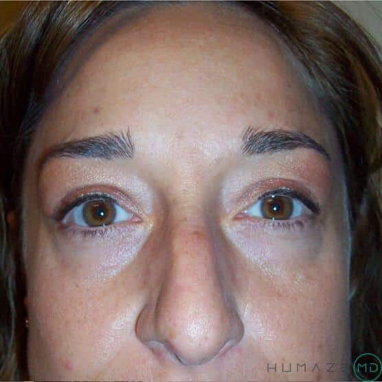 Blepharoplasty Before & After Image