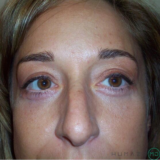 Blepharoplasty Before & After Image