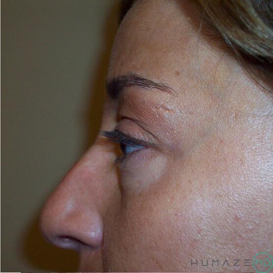 Blepharoplasty Before & After Image