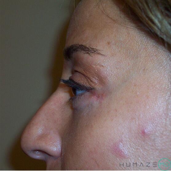 Blepharoplasty Before & After Image