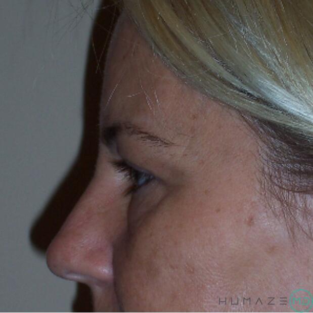 Blepharoplasty Before & After Image