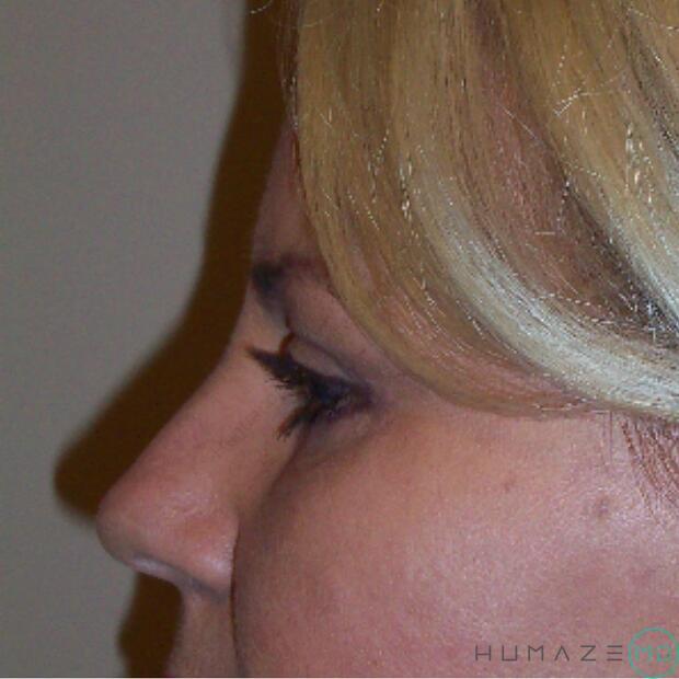 Blepharoplasty Before & After Image