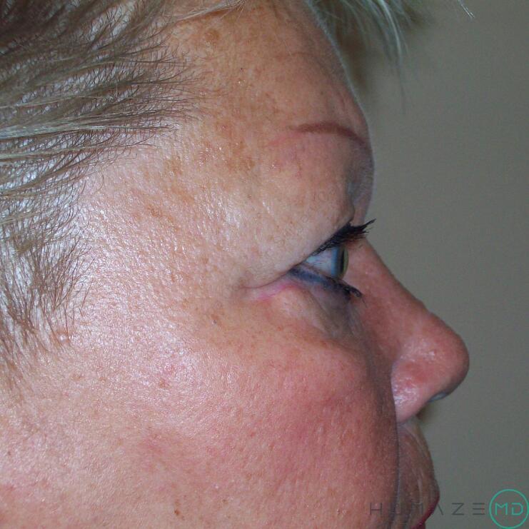 Blepharoplasty Before & After Image
