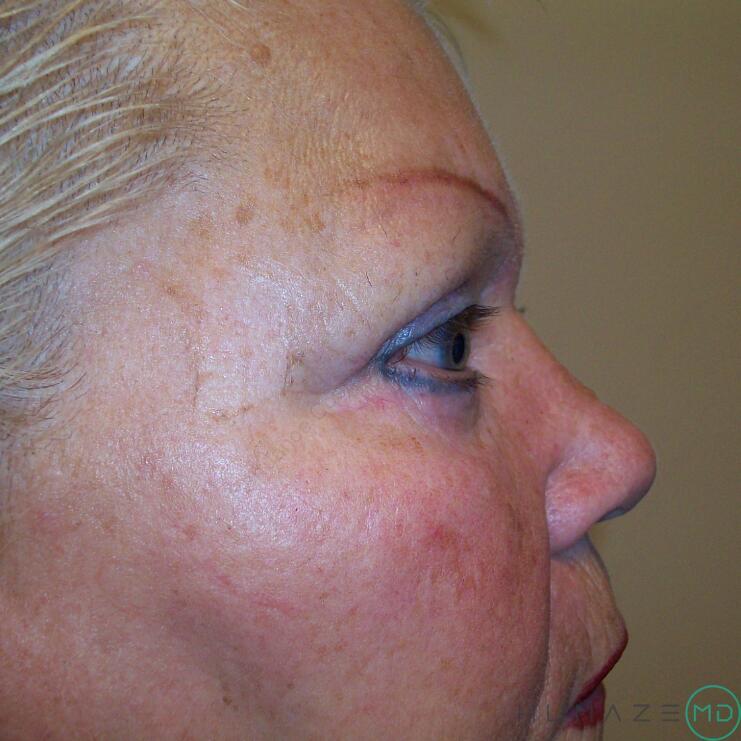 Blepharoplasty Before & After Image