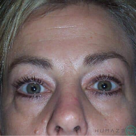 Blepharoplasty Before & After Image
