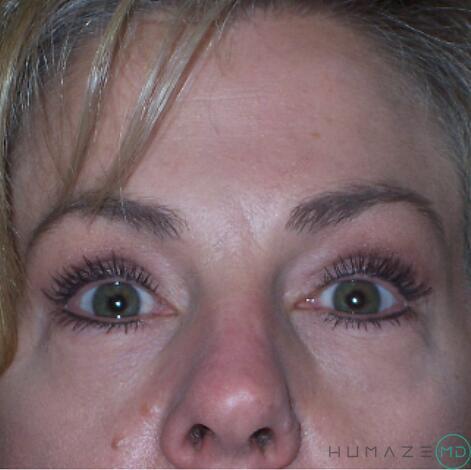 Blepharoplasty Before & After Image