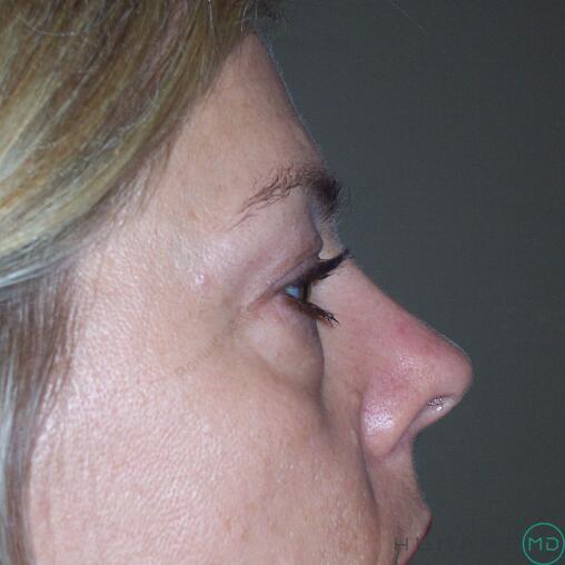 Blepharoplasty Before & After Image