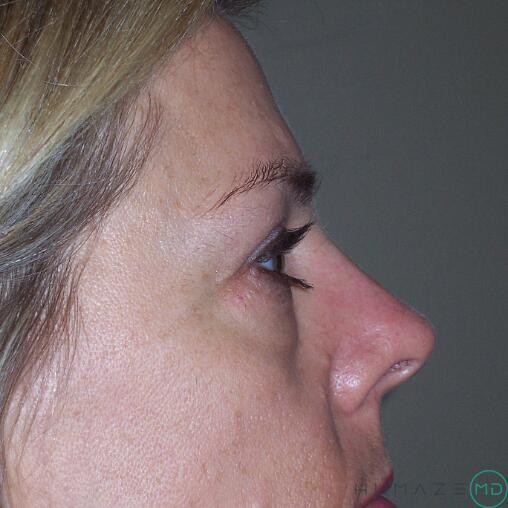 Blepharoplasty Before & After Image