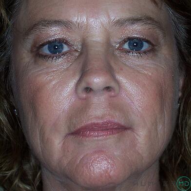 Blepharoplasty Before & After Image