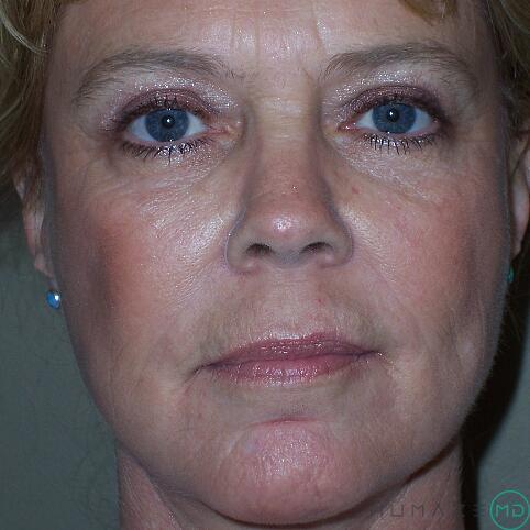 Blepharoplasty Before & After Image