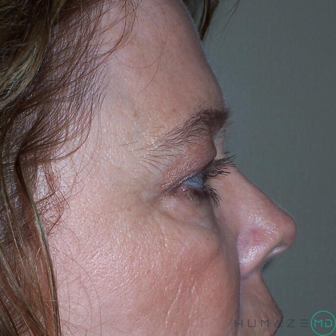 Blepharoplasty Before & After Image