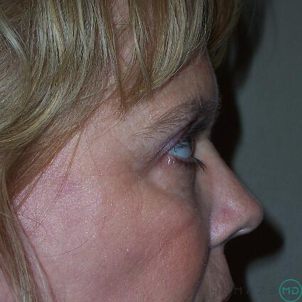 Blepharoplasty Before & After Image