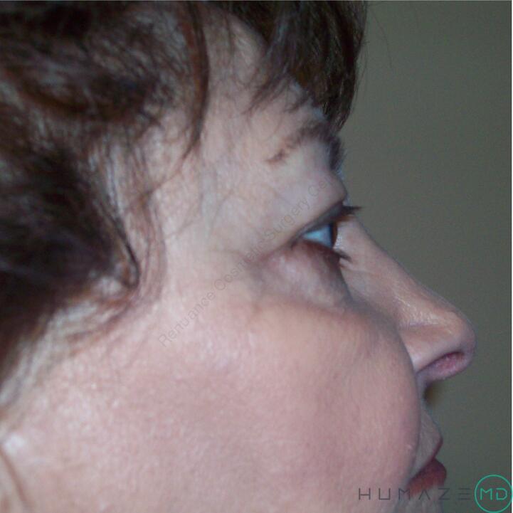 Blepharoplasty Before & After Image