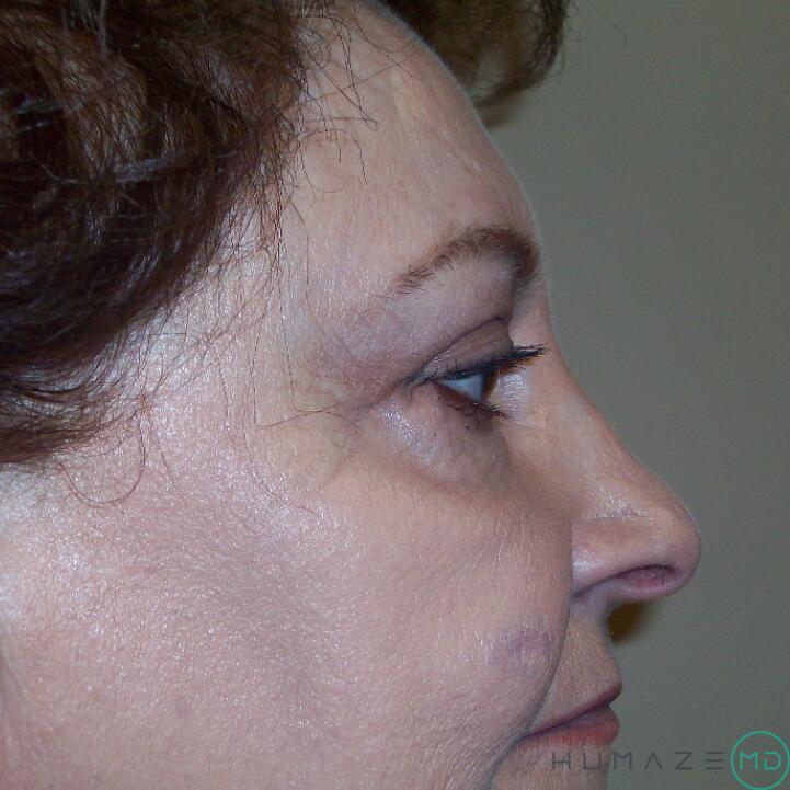 Blepharoplasty Before & After Image