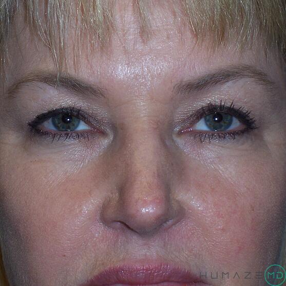 Blepharoplasty Before & After Image