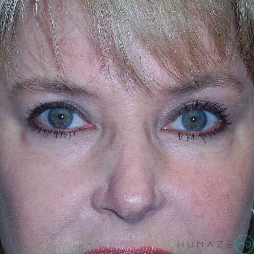 Blepharoplasty Before & After Image
