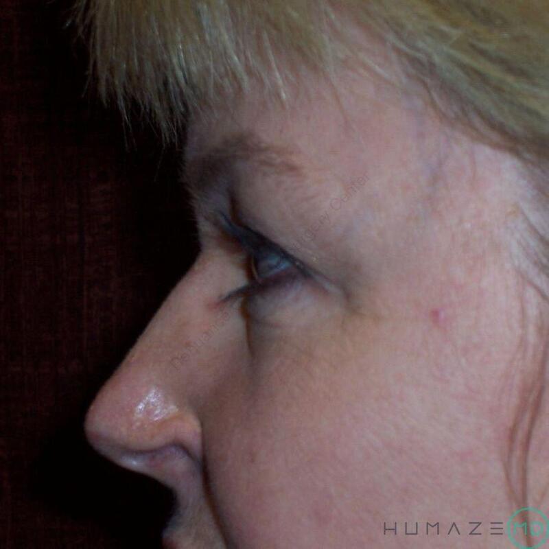 Blepharoplasty Before & After Image