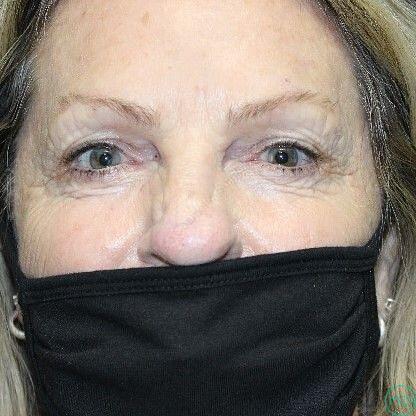 Blepharoplasty Before & After Image