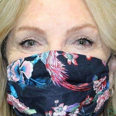 Blepharoplasty Before & After Image