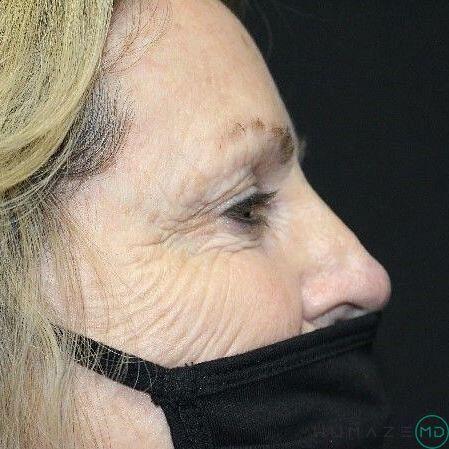 Blepharoplasty Before & After Image