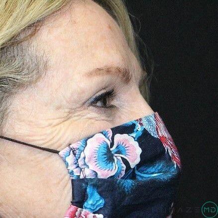 Blepharoplasty Before & After Image