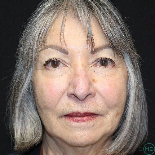 Laser Treatments Before & After Image