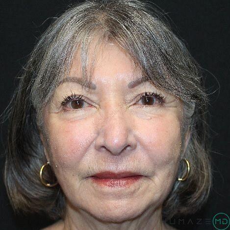 Laser Treatments Before & After Image