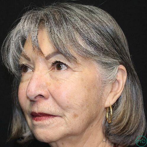 Laser Treatments Before & After Image