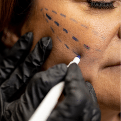 Close-up image of a person’s face with blue dotted lines on their cheek, likely marking areas for a cosmetic procedure. Hands in black gloves are holding a white marker near the marks on the skin.